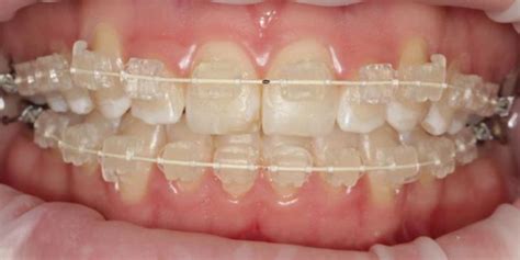 best orthodontist stratham